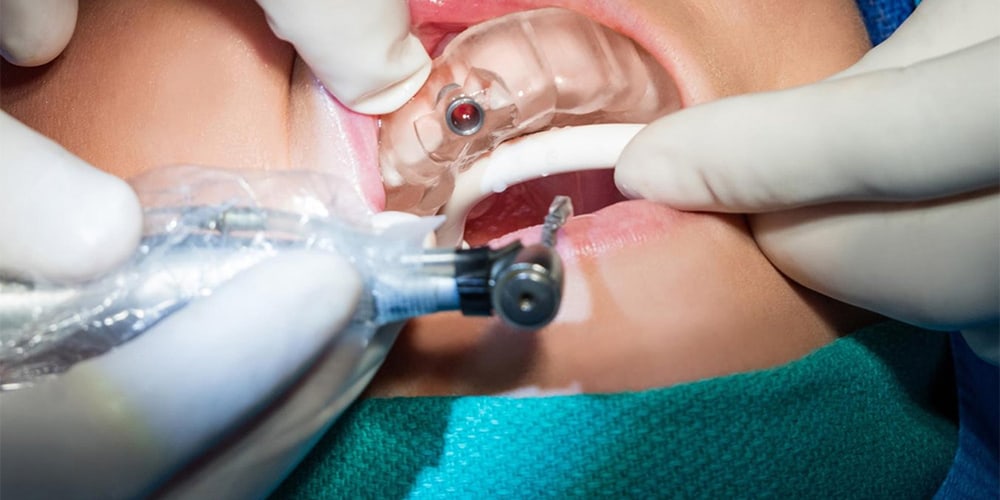 digital dental header
